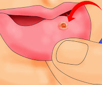 Lésions dans la bouche