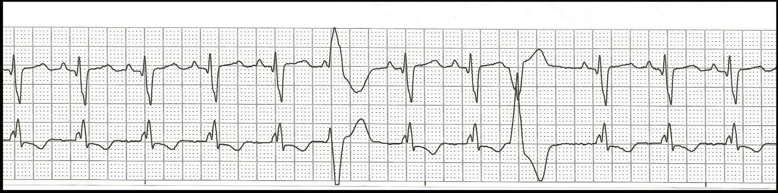 EKG Rhythm Strip Quiz 74