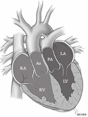 D-type transposition of the great arteries