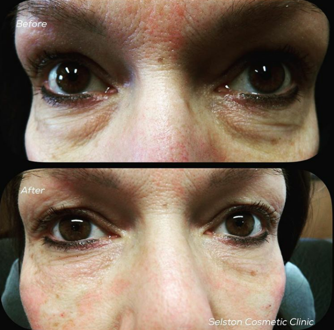 Selston Cosmetic Clinic Combat Facial Ageing With Dermal Fillers