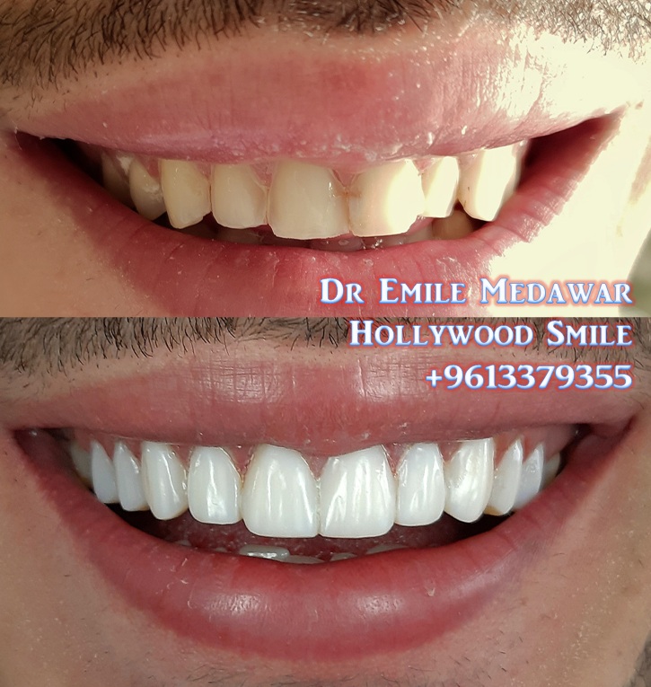 Dental Implant before after, Dr Emile Medawar, 00 961 3 379355
