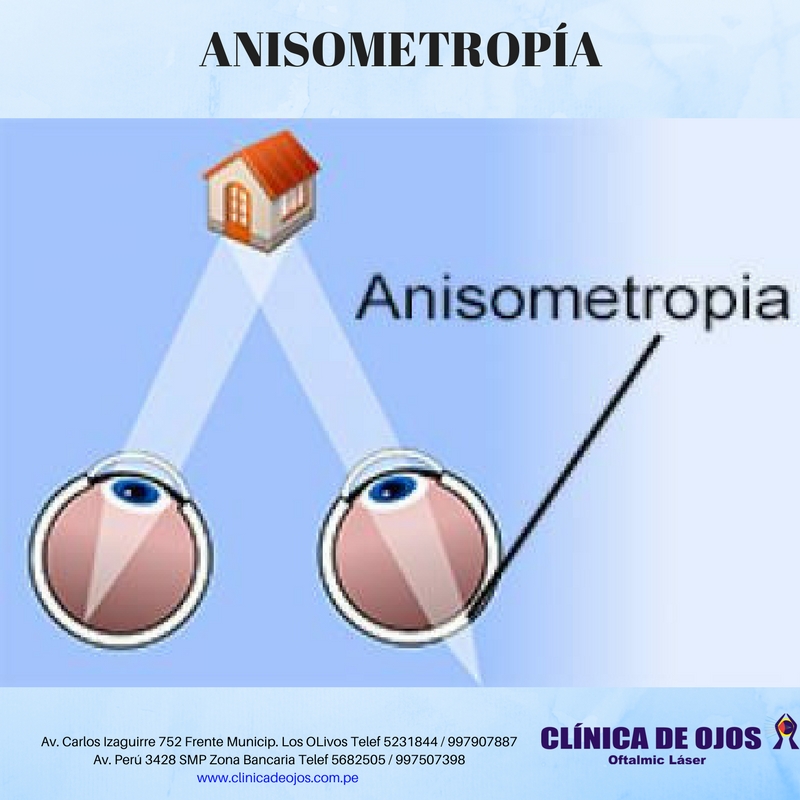 Clínica de Ojos Oftalmic Láser ANISOMETROPIA