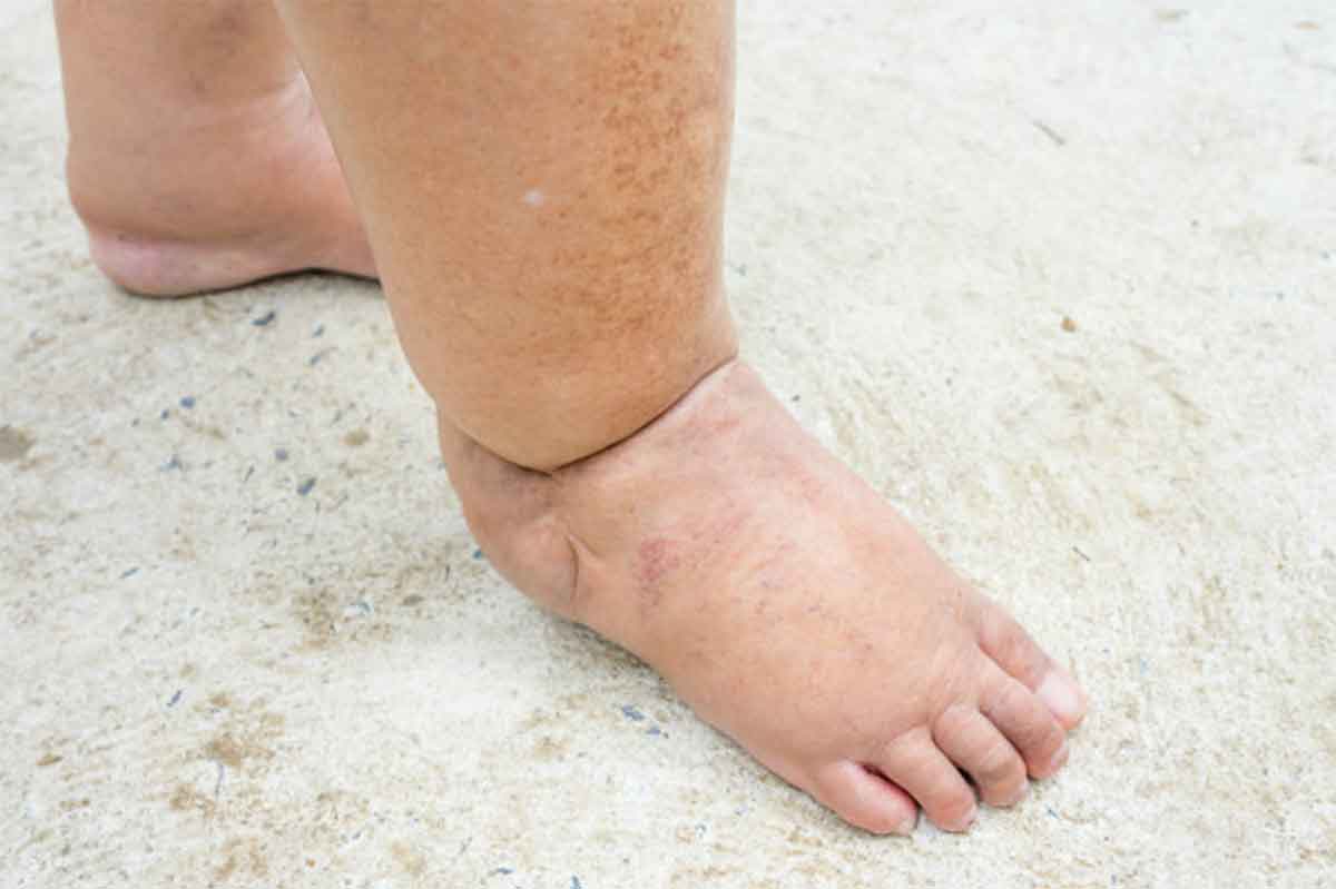 swollen and diabetic feet
