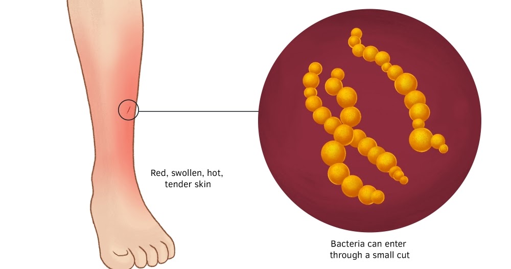CELLULITIS Medical Yukti
