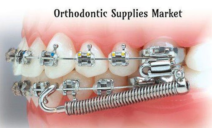 DENTAL NEWS: Orthodontic Supplies Market Analysis Focusing on Top Key Players