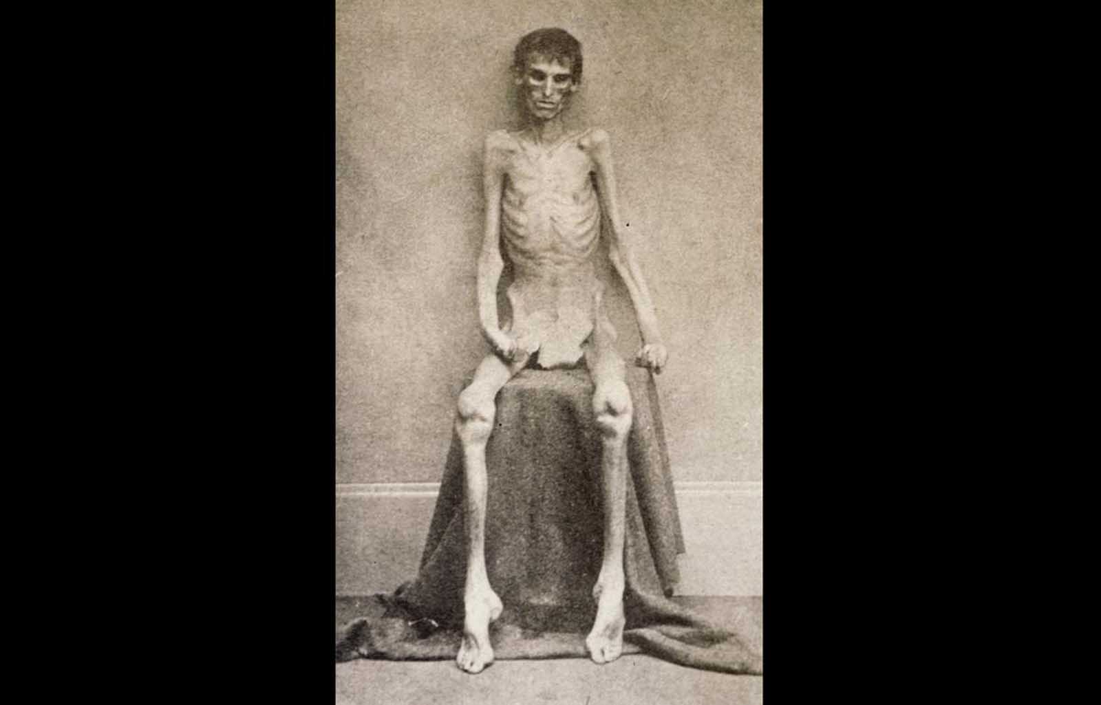 A nearly-starved Union soldier who survived imprisonment in the notorious Confederate prison in Andersonville, Georgia.