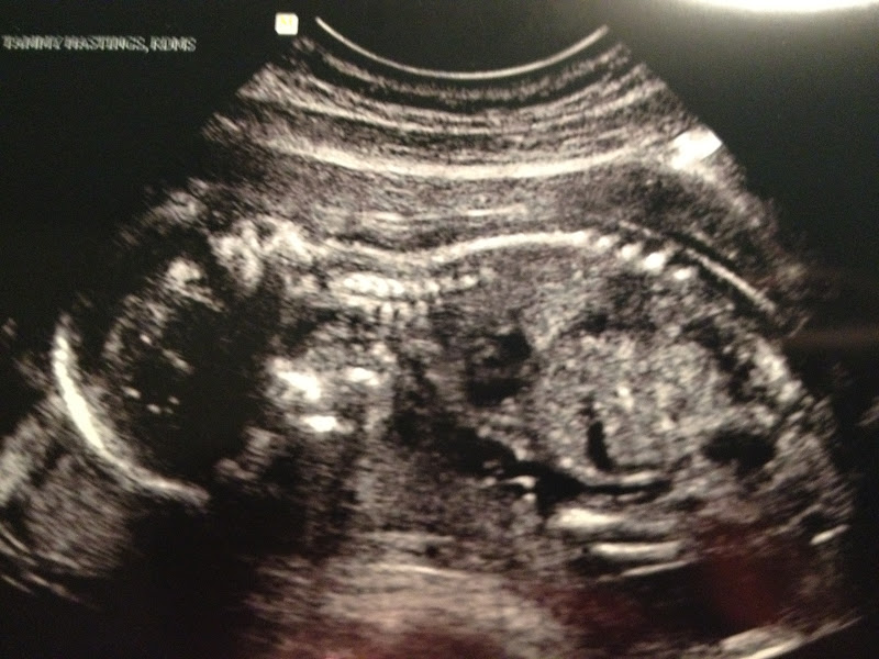Little Baby Barton Gender/anatomy scan time!