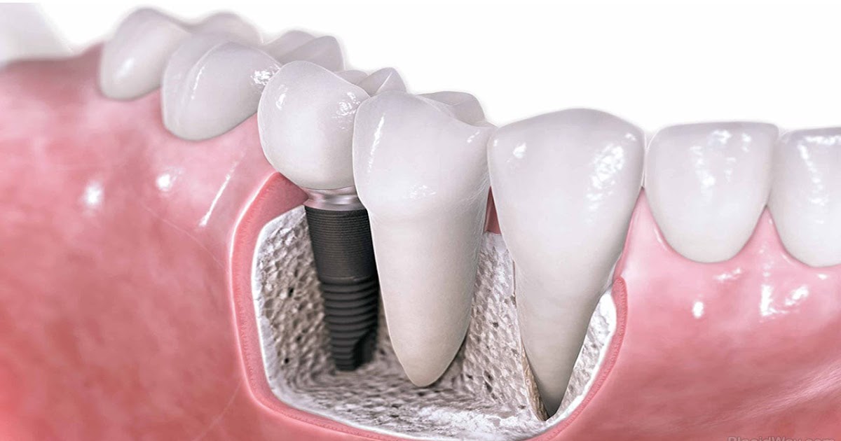 Dental Implants Cost How Much Does It Cost?