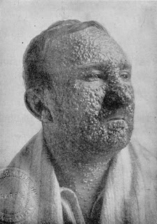 Amerika Birleşik Devletleri'nde çiçek hastalığı olan bir kişi, 1912