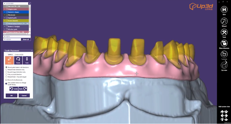 Dental CAD/CAM system: Implant Bridge design by exocad