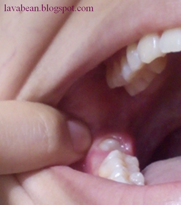 Oral Surgery Wisdom Tooth 49