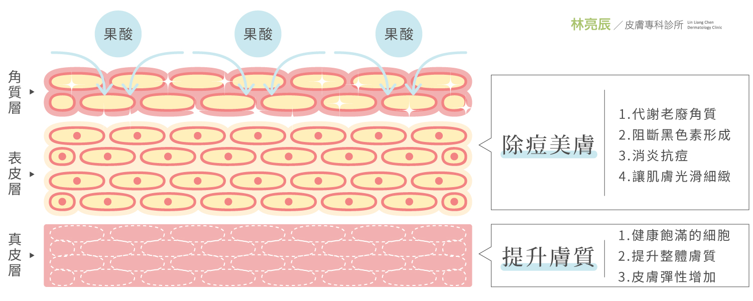  改善痘痘肌、粉刺、出油及毛孔粗大，油性膚質調理
