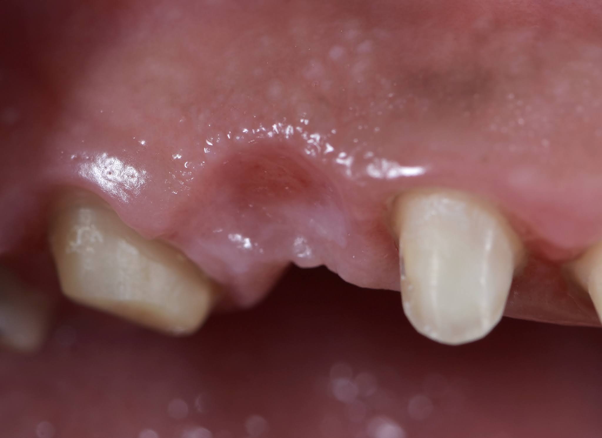 Dental Esthetics Ovate pontic for the correct emergence profile.. A clinical case