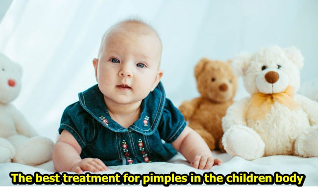 The best treatment for pimples in the children body The best treatment for pimples in the children body