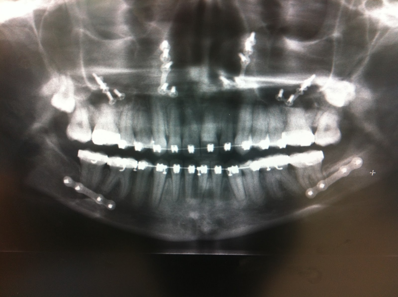A Guide to Surviving Orthognathic Surgery Sinus Infections after Surgery