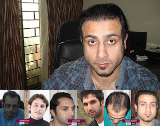hair transplant in Pakistan
