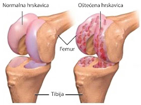 liječenje artroze stopala solju)
