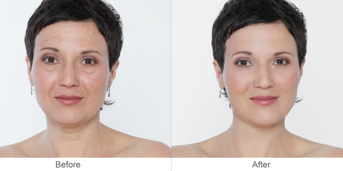 Before and After Dermal Filler Treatment Before and After Dermal Filler Treatment