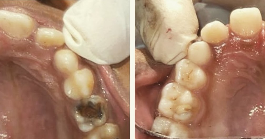 Case Report Single Visit Pulpectomy and Stainless Steel Crown