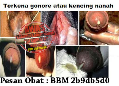 Penis Keluar Nanah Sedikit Tapi Tidak Sakit