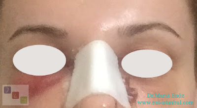 Bruising and Swelling After Nose Job