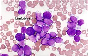 Penampakan Limfoblast Pada Akut Limfoblastik Leukemia