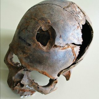 Weltzin-human-skull-with-large-fracture-photograph-D-Jantzen_Q320.jpg