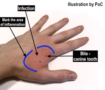 Cat bite signs of infection