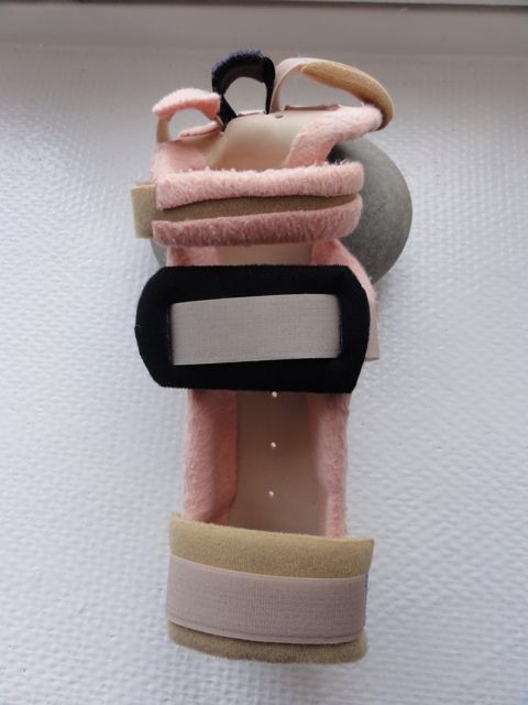 Handrehabilitationcase with Dupuytren's contracture.: A trauma in the ...