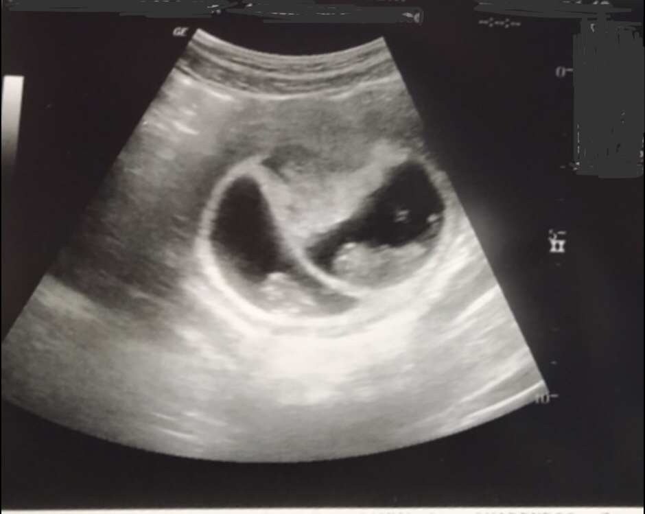 Twin Pregnancy Belly Week By Week + Symptoms & Ultrasounds - Morgan