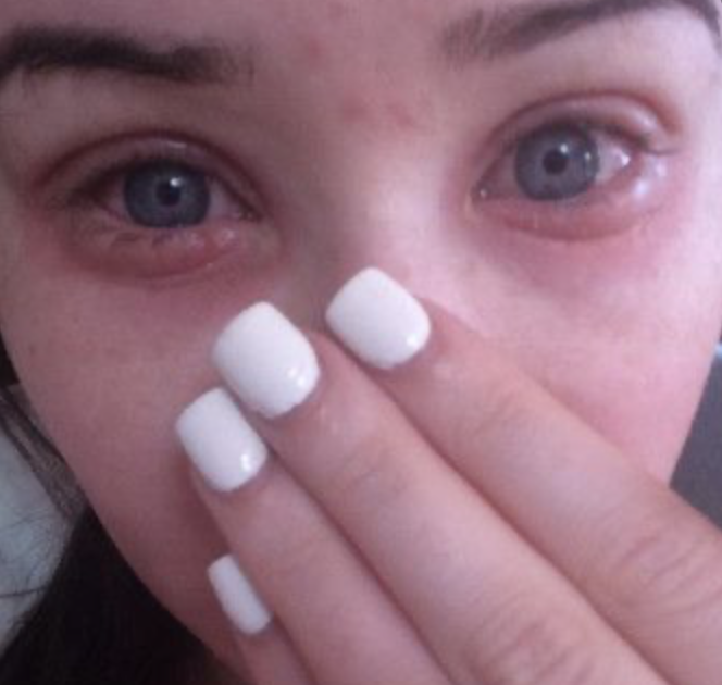 Confessions of a Lash Extension Tech Allergic reactions to eyelash