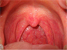 FARINGITIS EN BEBES FARINGITIS EN BEBES