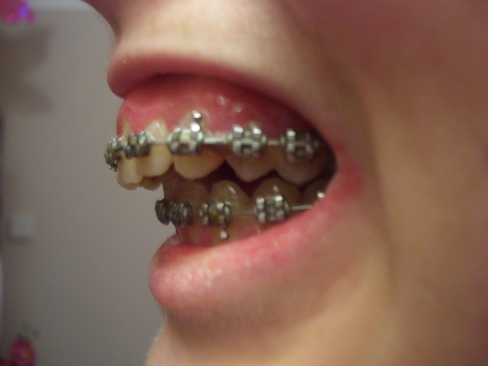 My Jaw Surgery Story 8 months of braces and a bracket on every tooth!