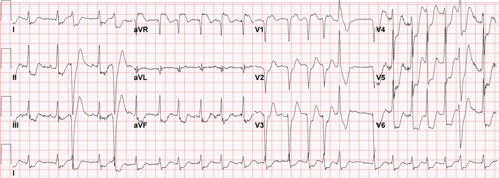 Dr Smith S Ecg Blog St Elevation In Avr With Diffuse St