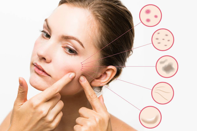 Cẩm nang skincare cho da mụn nàng phải ĐỌC NGAY!