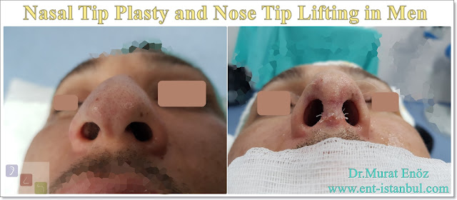 Droopy nose tip - Nasal tip plasty in men istanbul