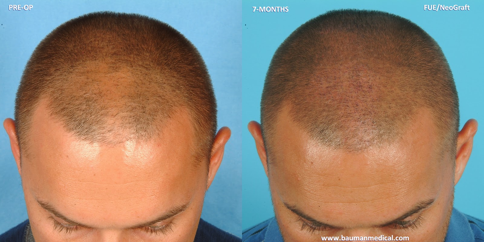 Neograft Curly Hair Hair Transplant Cost In Pakistan