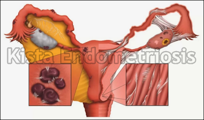 http://arumherbal30.blogspot.com/2018/07/cara-mengobati-kista-endometriosis.html