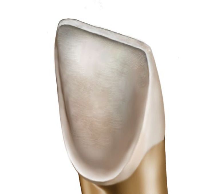 Ceramic veneers preparartion .. Part 2 " Conventional preparation " Dental Esthetics