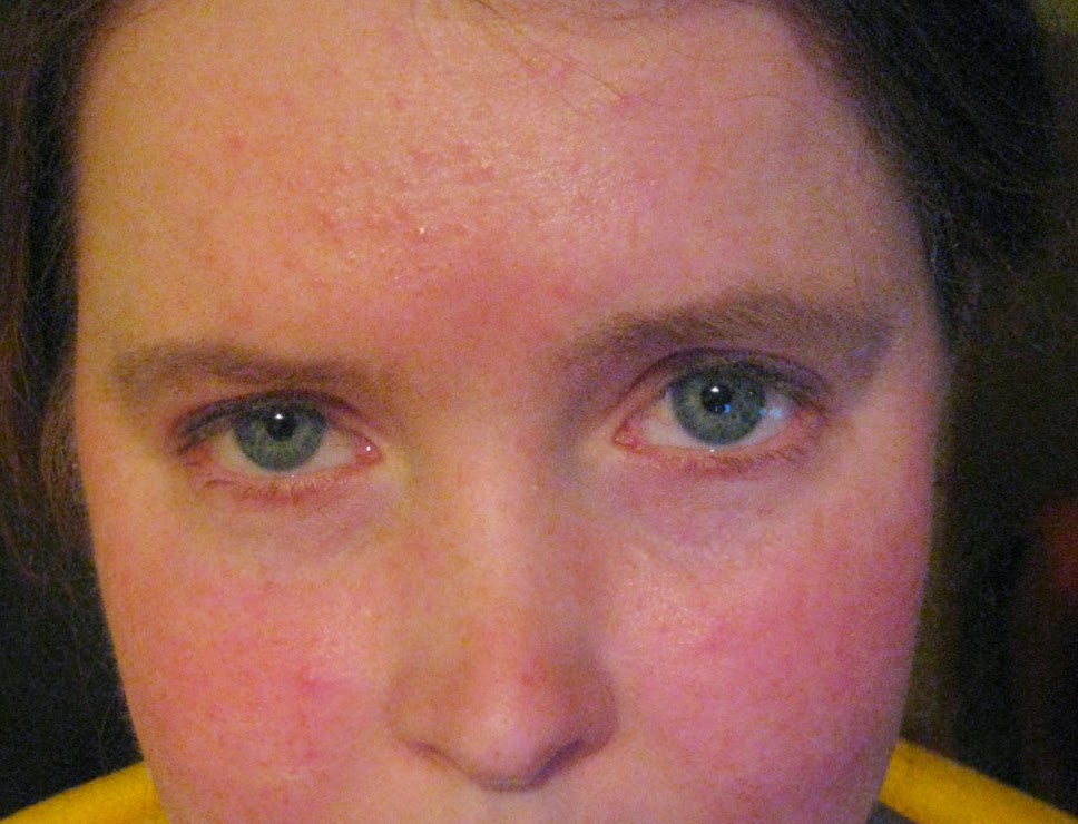 Scarlet Letters, dealing with vascular rosacea, face flushing, burning