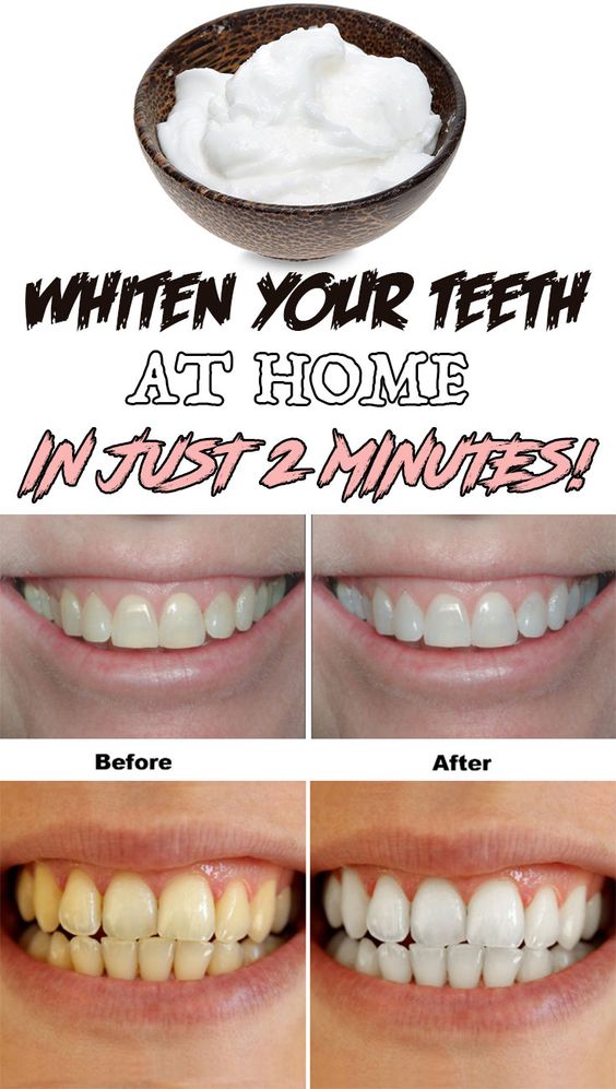 Whiten Your Teeth At Home In Just 2 Minutes! Healthy Prize
