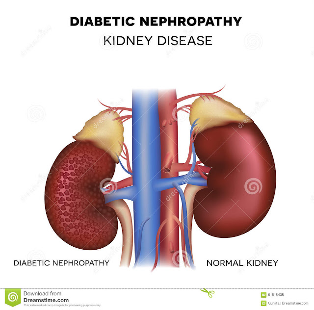 how to protect kidney damage from diabetes