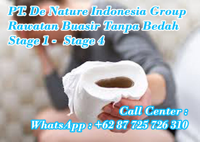 ubat kurangkan bengkak buasir paling dipercayai