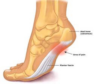 Surgery Treatment For Plantar Fasciitis