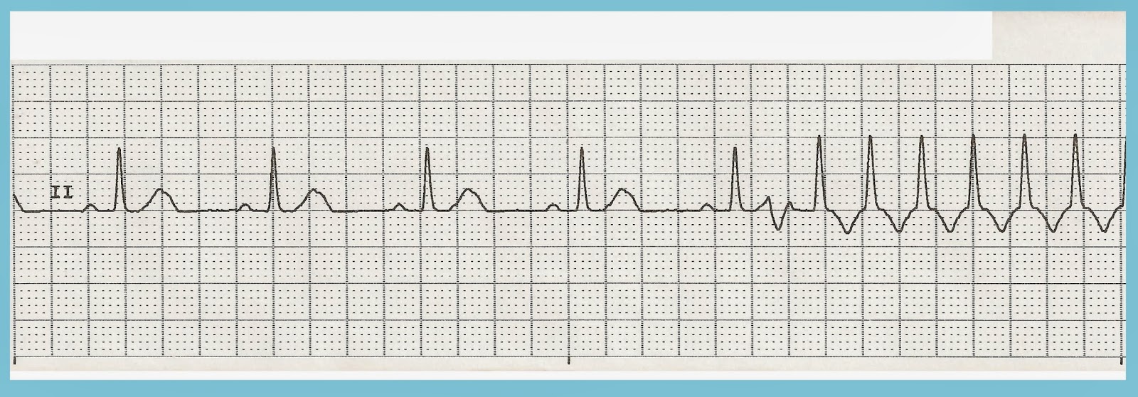 Float Nurse: Practice EKG Rhythm Strips 234