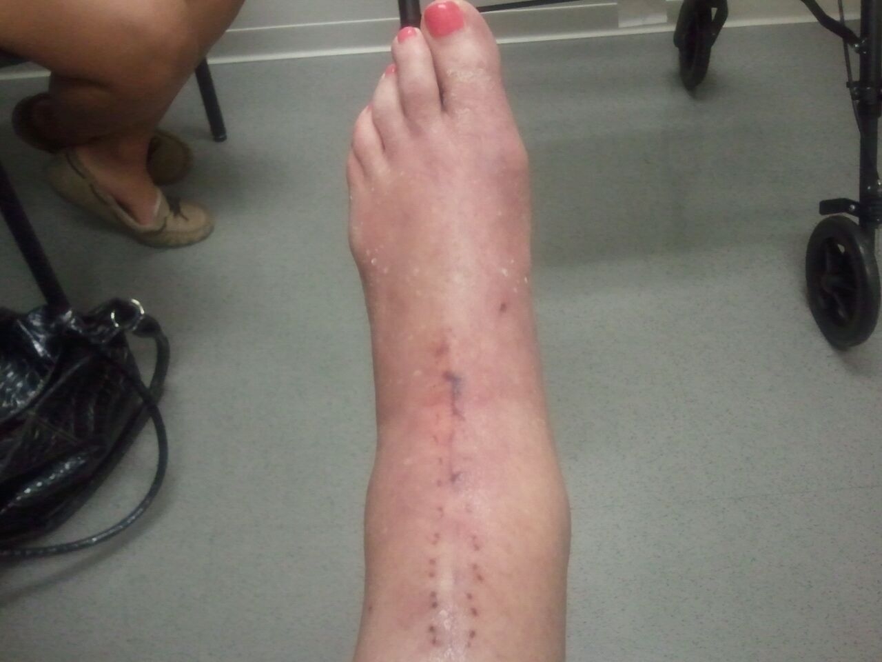 My Total Ankle Replacement Week Six Post op visit and PAIN!