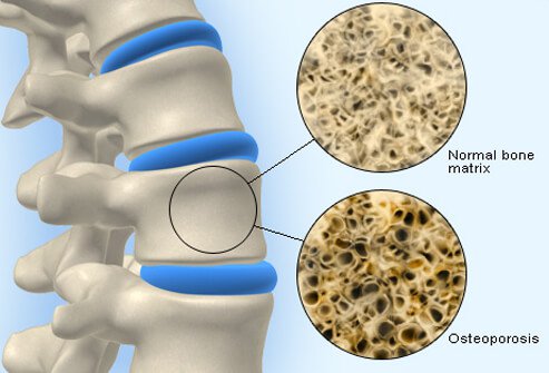 Osteoporosis is the cause of low back pain