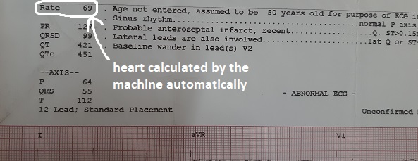 heart rate calculation in ecg