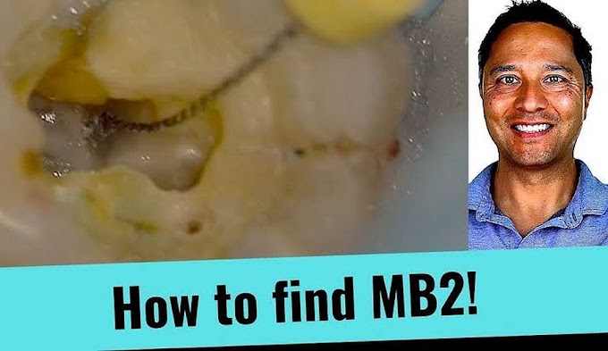 ENDODONTICS: How to the find MB2 Canal (Simple Tips)