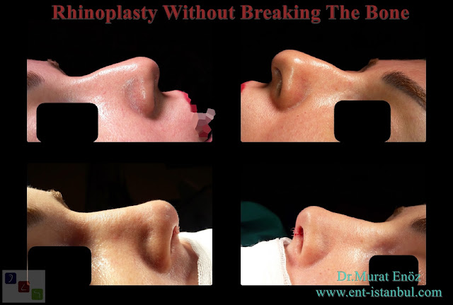 Bruising After Rhinoplasty without bone breaking,Swelling After Nose Job Without Touching The Bone,Nose aesthetic surgery without breaking bone, Nose tip plasty, Nose hump reduction